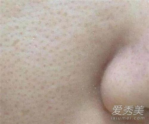 毛孔里面白色的颗粒是什么 毛孔里面白色颗粒怎么去除