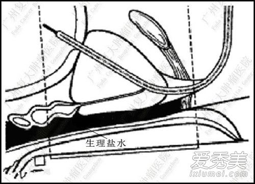 生理盐水是什么 生理盐水的功效与作用