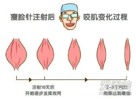 打瘦脸针副作用